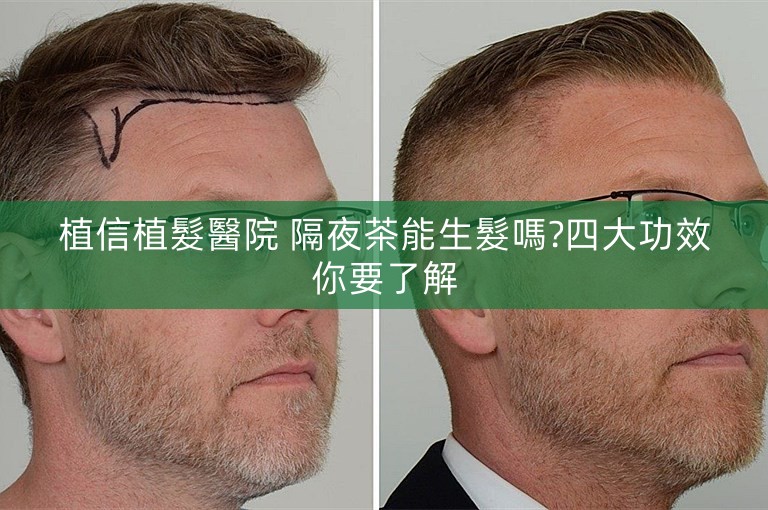 植信植髮醫院 隔夜茶能生髮嗎?四大功效你要了解
