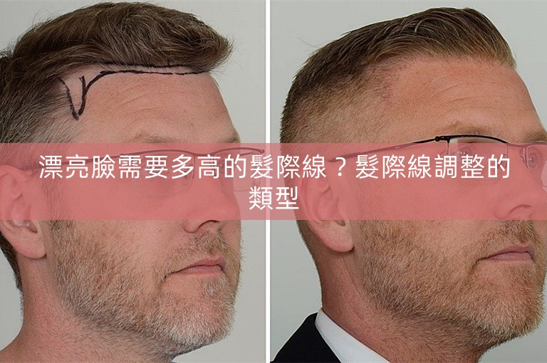 漂亮臉需要多高的髮際線？髮際線調整的類型