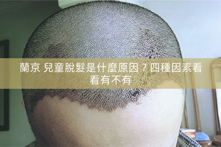 蘭京 兒童脫髮是什麼原因？四種因素看看有不有