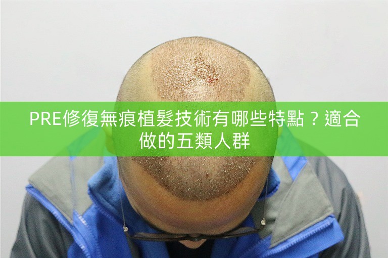 PRE修復無痕植髮技術有哪些特點？適合做的五類人群