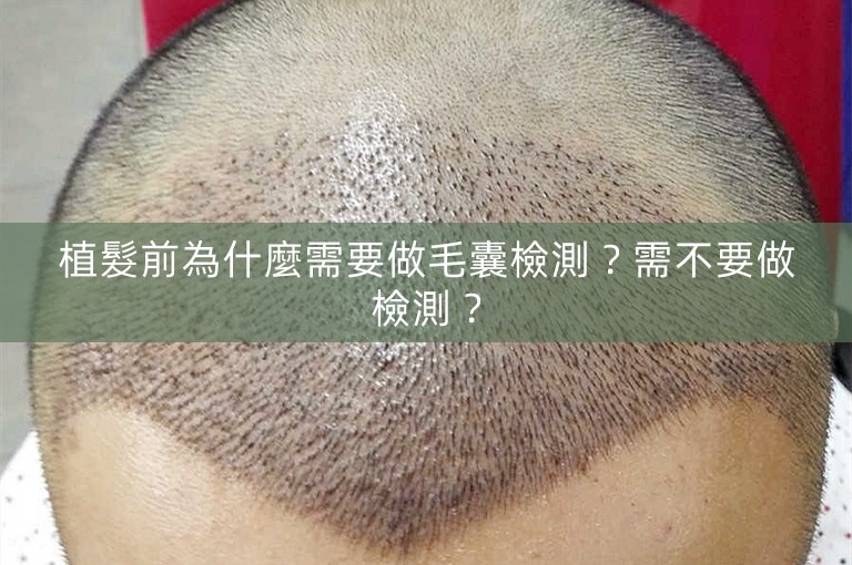 植髮前為什麼需要做毛囊檢測?需不要做檢測? 植髮前為什麼需要做毛囊檢測?需不要做檢測?