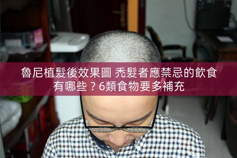 魯尼植髮後效果圖 禿髮者應禁忌的飲食有哪些？6類食物要多補充