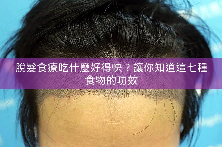 脫髮食療吃什麼好得快?讓你知道這七種食物的功效 脫髮食療吃什麼好得快?讓你知道這七種食物的功效