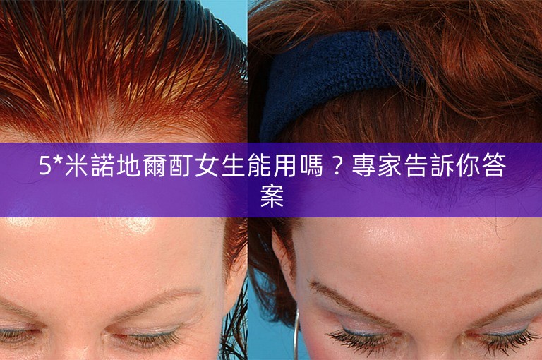 5*米諾地爾酊女生能用嗎？專家告訴你答案