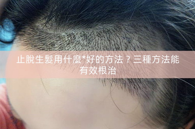 止脫生髮用什麼*好的方法？三種方法能有效根治