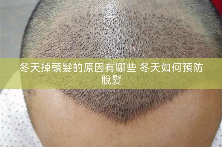 冬天掉頭髮的原因有哪些 冬天如何預防脫髮 冬天掉頭髮的原因有哪些 冬天如何預防脫髮