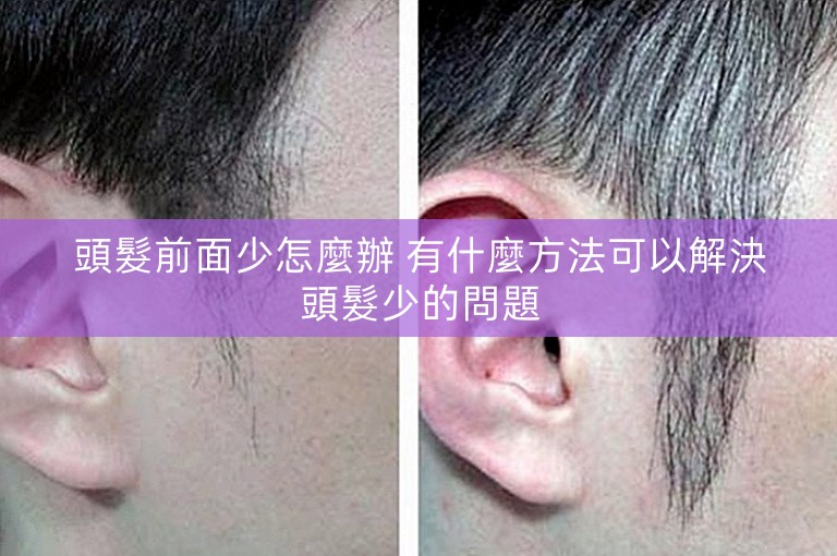 頭髮前面少怎麼辦 有什麼方法可以解決頭髮少的問題