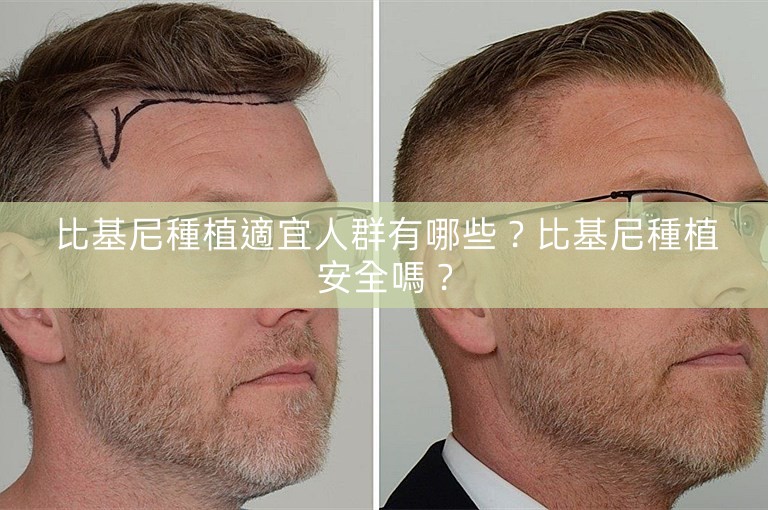 比基尼種植適宜人群有哪些?比基尼種植安全嗎? 比基尼種植適宜人群有哪些?比基尼種植安全嗎?