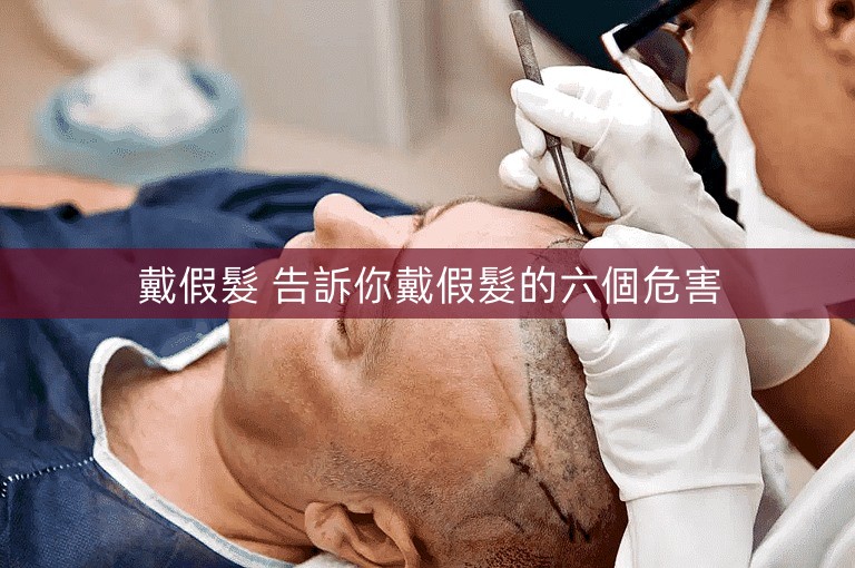 戴假髮 告訴你戴假髮的六個危害 戴假髮 告訴你戴假髮的六個危害