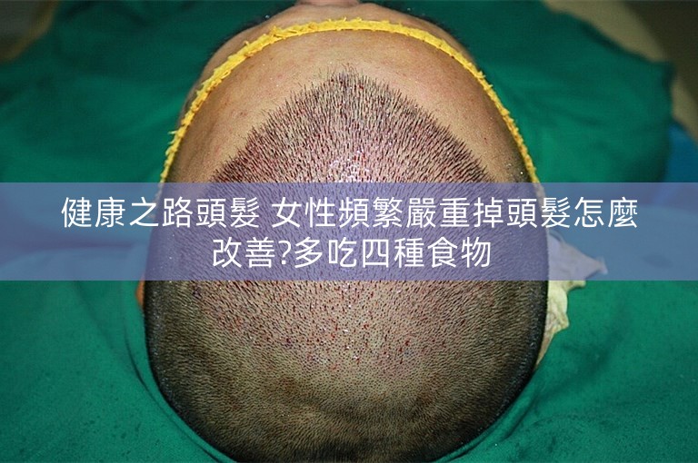 健康之路頭髮 女性頻繁嚴重掉頭髮怎麼改善?多吃四種食物