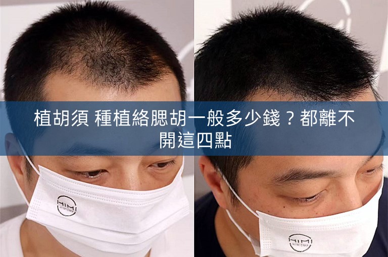 植胡須 種植絡腮胡一般多少錢?都離不開這四點 植胡須 種植絡腮胡一般多少錢?都離不開這四點
