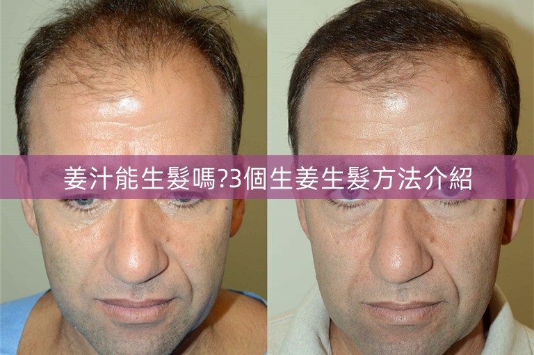 姜汁能生髮嗎?3個生姜生髮方法介紹