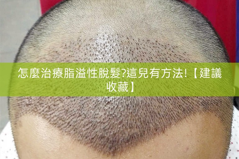 怎麼治療脂溢性脫髮?這兒有方法!【建議收藏】