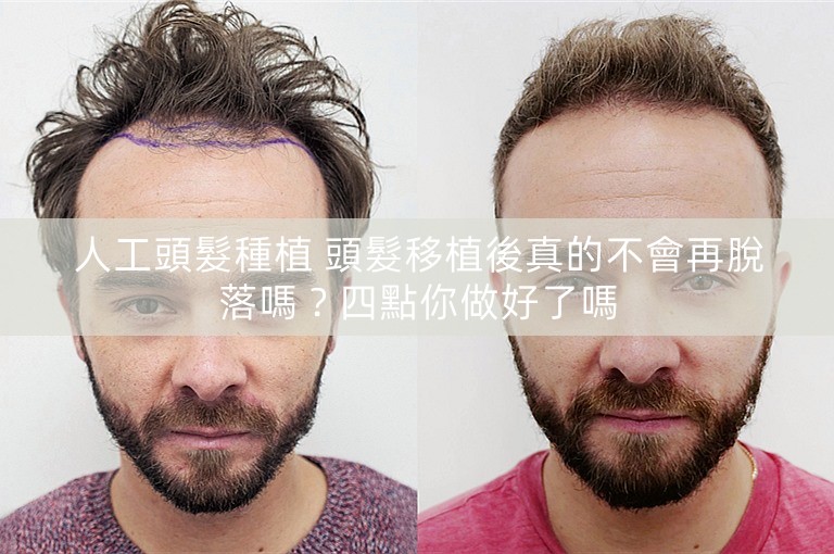 人工頭髮種植 頭髮移植後真的不會再脫落嗎？四點你做好了嗎