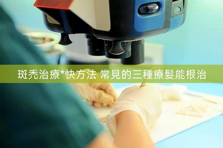 斑禿治療*快方法 常見的三種療髮能根治