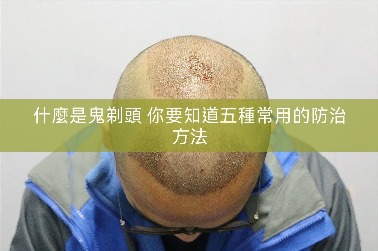 什麼是鬼剃頭 你要知道五種常用的防治方法