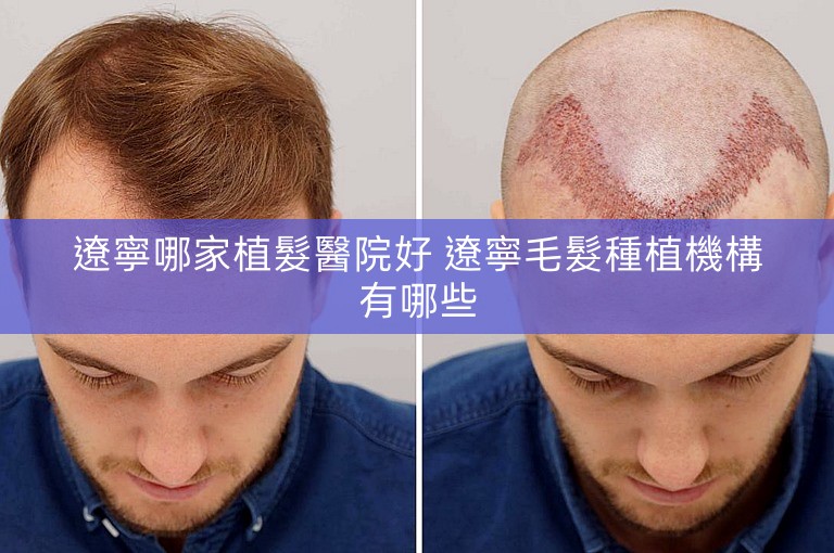 遼寧哪家植髮醫院好 遼寧毛髮種植機構有哪些