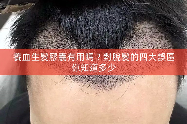 養血生髮膠囊有用嗎？對脫髮的四大誤區你知道多少