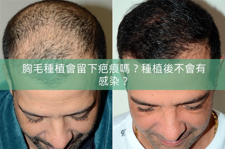  胸毛種植會留下疤痕嗎？種植後不會有感染？