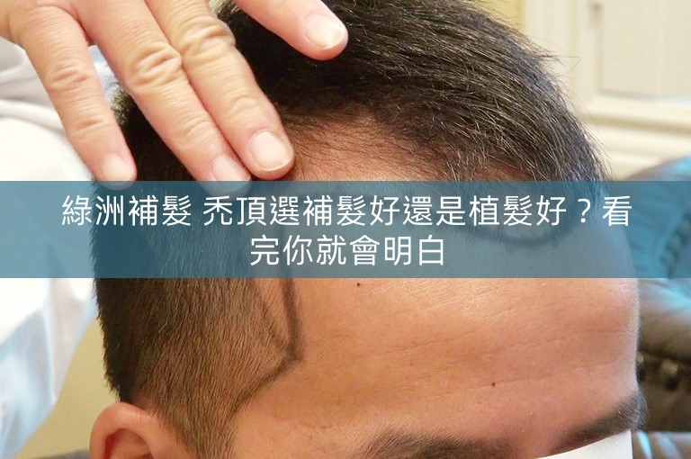 綠洲補髮 禿頂選補髮好還是植髮好？看完你就會明白