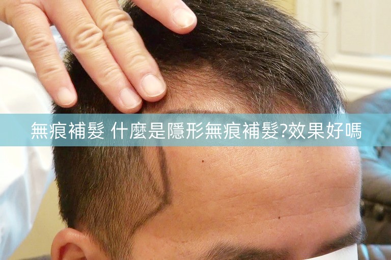 無痕補髮 什麼是隱形無痕補髮?效果好嗎
