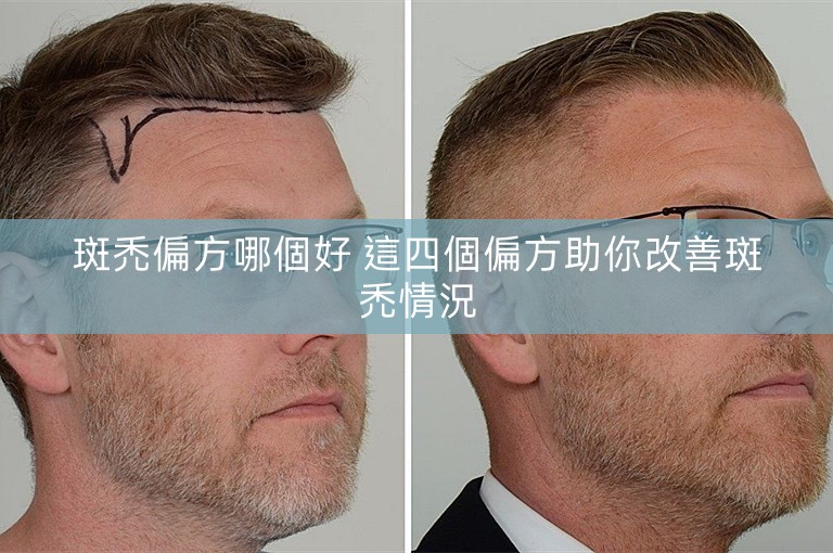 斑禿偏方哪個好 這四個偏方助你改善斑禿情況