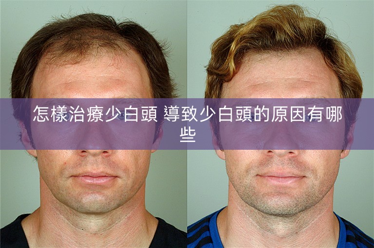 怎樣治療少白頭 導致少白頭的原因有哪些