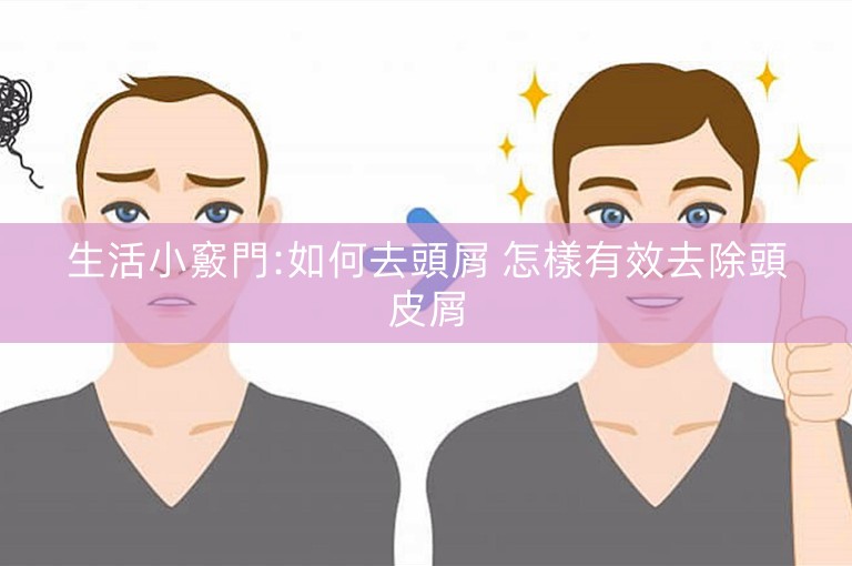 生活小竅門:如何去頭屑 怎樣有效去除頭皮屑 生活小竅門:如何去頭屑 怎樣有效去除頭皮屑
