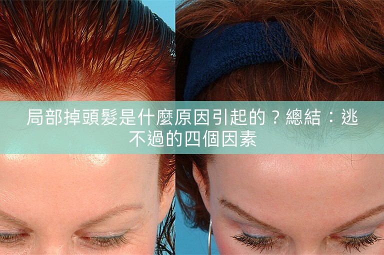 局部掉頭髮是什麼原因引起的？總結：逃不過的四個因素