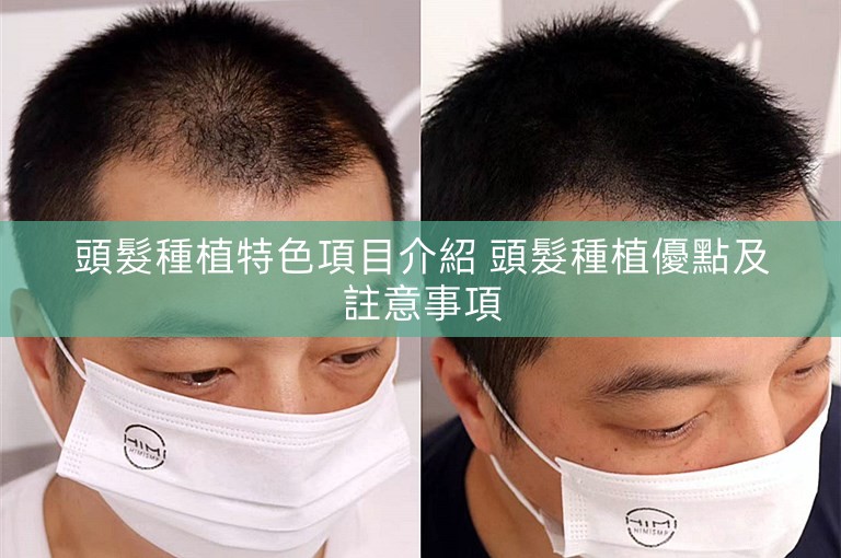 頭髮種植特色項目介紹 頭髮種植優點及註意事項 頭髮種植特色項目介紹 頭髮種植優點及註意事項