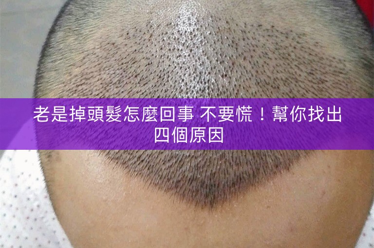 老是掉頭髮怎麼回事 不要慌！幫你找出四個原因