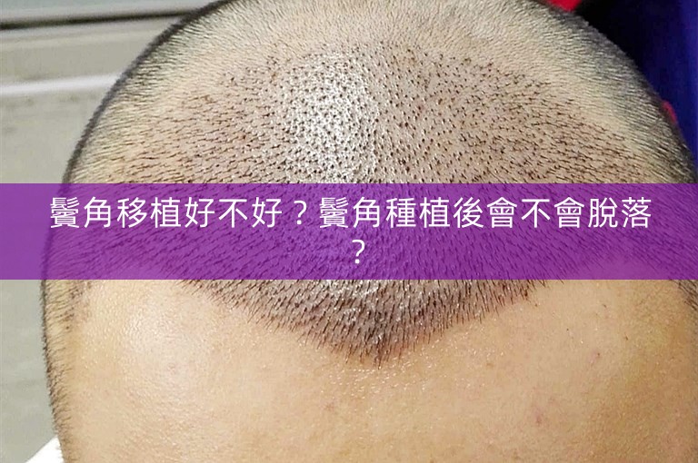 鬢角移植好不好？鬢角種植後會不會脫落？