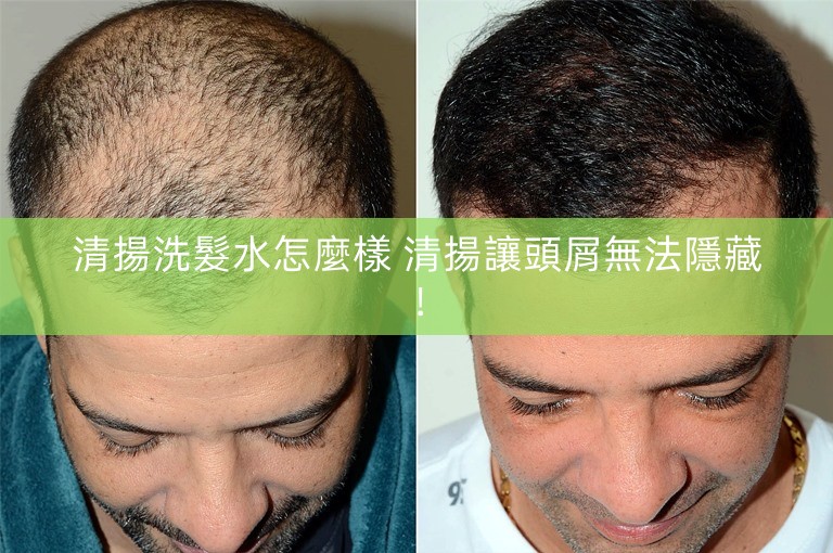 清揚洗髮水怎麼樣 清揚讓頭屑無法隱藏!