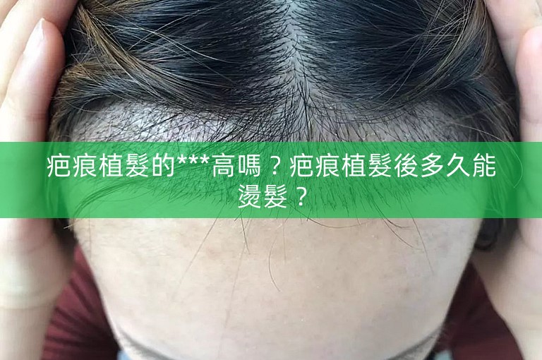 疤痕植髮的***高嗎?疤痕植髮後多久能燙髮? 疤痕植髮的***高嗎?疤痕植髮後多久能燙髮?