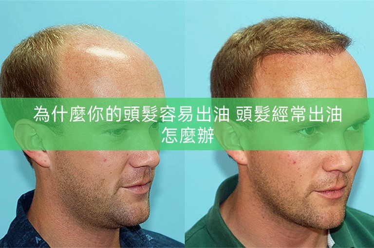 為什麼你的頭髮容易出油 頭髮經常出油怎麼辦 為什麼你的頭髮容易出油 頭髮經常出油怎麼辦