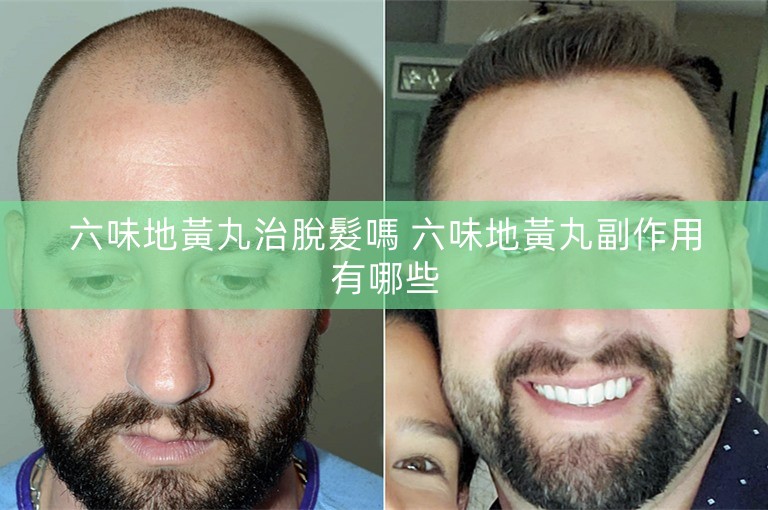 六味地黃丸治脫髮嗎 六味地黃丸副作用有哪些