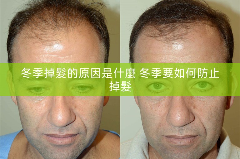 冬季掉髮的原因是什麼 冬季要如何防止掉髮
