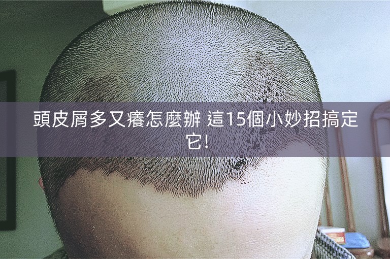 頭皮屑多又癢怎麼辦 這15個小妙招搞定它!