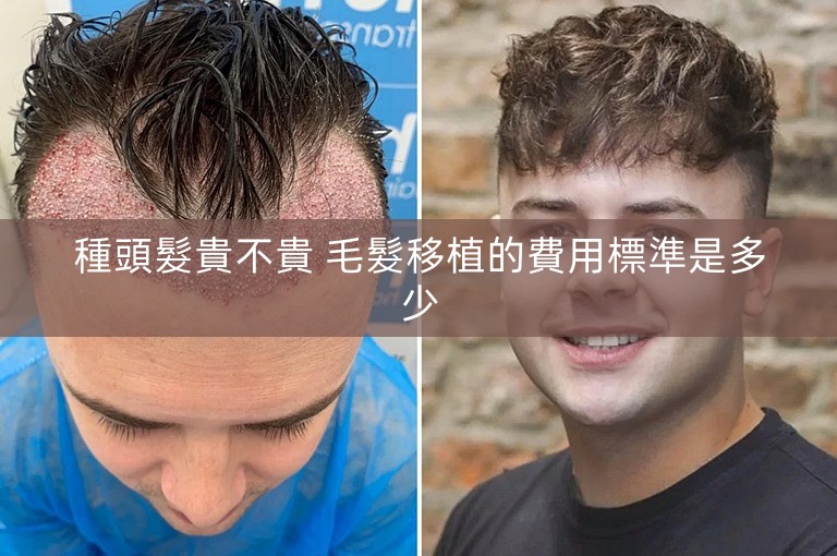 種頭髮貴不貴 毛髮移植的費用標準是多少