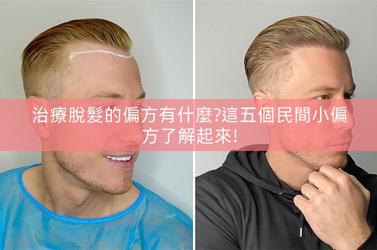 治療脫髮的偏方有什麼?這五個民間小偏方了解起來!