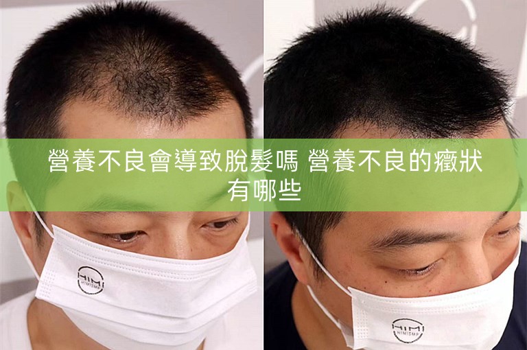 營養不良會導致脫髮嗎 營養不良的癥狀有哪些