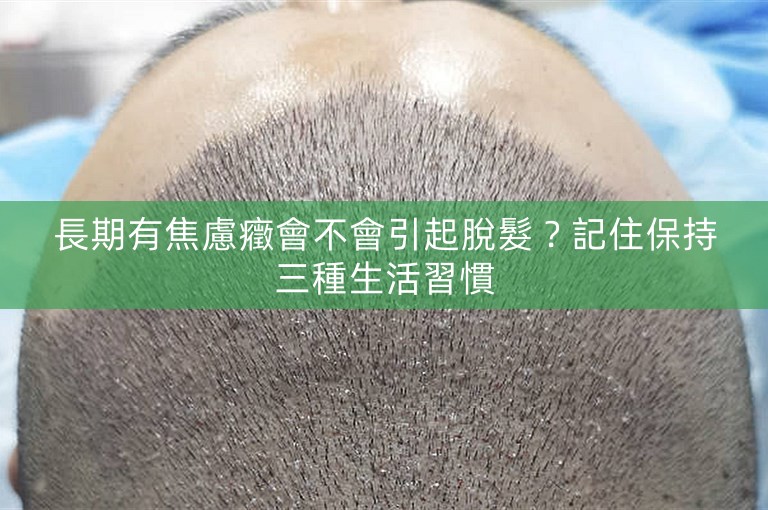 長期有焦慮癥會不會引起脫髮？記住保持三種生活習慣