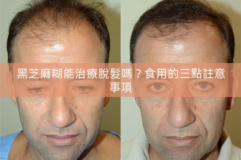 黑芝麻糊能治療脫髮嗎?食用的三點註意事項 黑芝麻糊能治療脫髮嗎?食用的三點註意事項