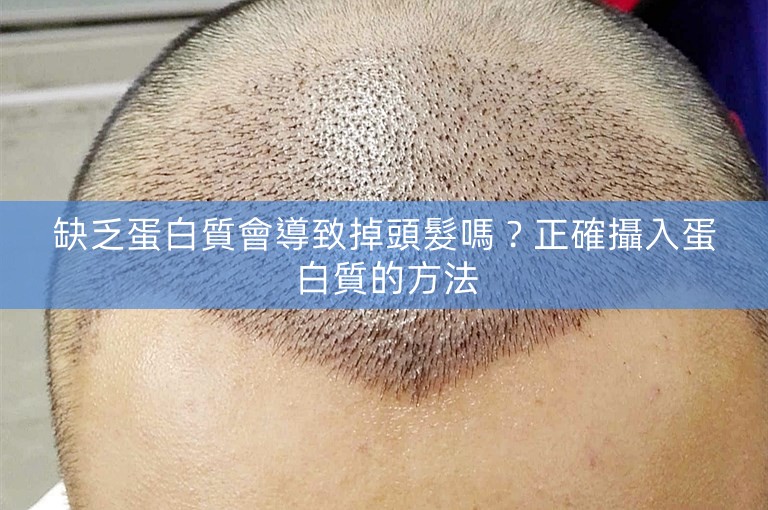 缺乏蛋白質會導致掉頭髮嗎?正確攝入蛋白質的方法 缺乏蛋白質會導致掉頭髮嗎?正確攝入蛋白質的方法