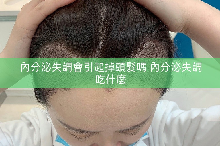 內分泌失調會引起掉頭髮嗎 內分泌失調吃什麼 內分泌失調會引起掉頭髮嗎 內分泌失調吃什麼