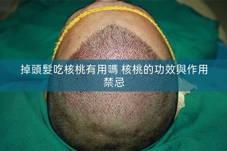 掉頭髮吃核桃有用嗎 核桃的功效與作用禁忌 掉頭髮吃核桃有用嗎 核桃的功效與作用禁忌