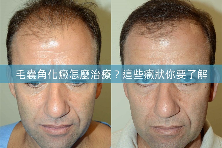 毛囊角化癥怎麼治療?這些癥狀你要了解 毛囊角化癥怎麼治療?這些癥狀你要了解