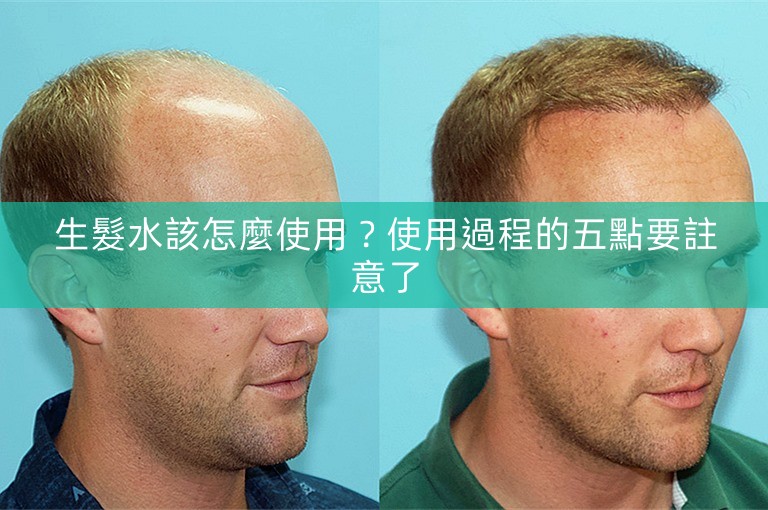 生髮水該怎麼使用?使用過程的五點要註意了 生髮水該怎麼使用?使用過程的五點要註意了