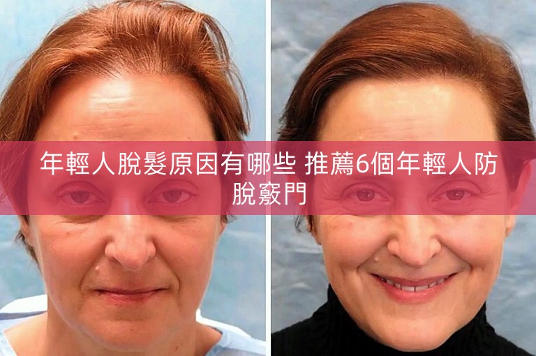 年輕人脫髮原因有哪些 推薦6個年輕人防脫竅門