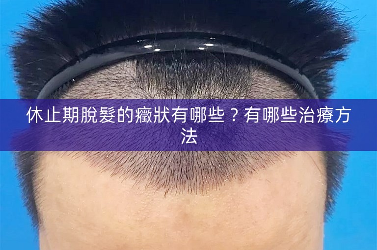 休止期脫髮的癥狀有哪些？有哪些治療方法
